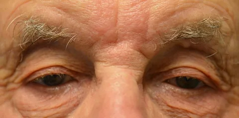 Before ptosis surgery