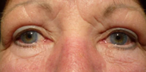 After upper eyelid surgery