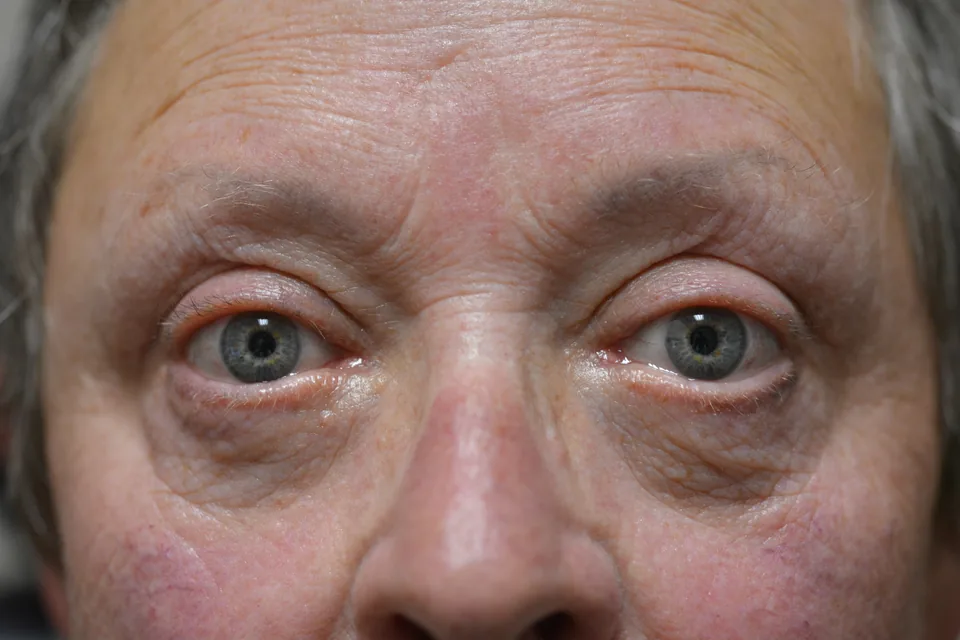 After lower eyelid surgery