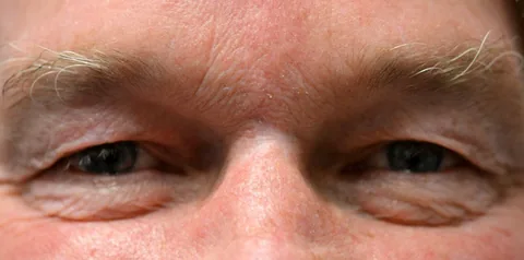 Before upper eyelid surgery