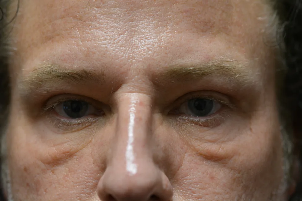 After eyelid surgery