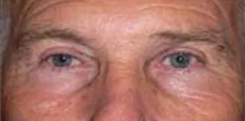After upper eyelid surgery