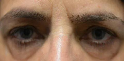 Before upper eyelid surgery