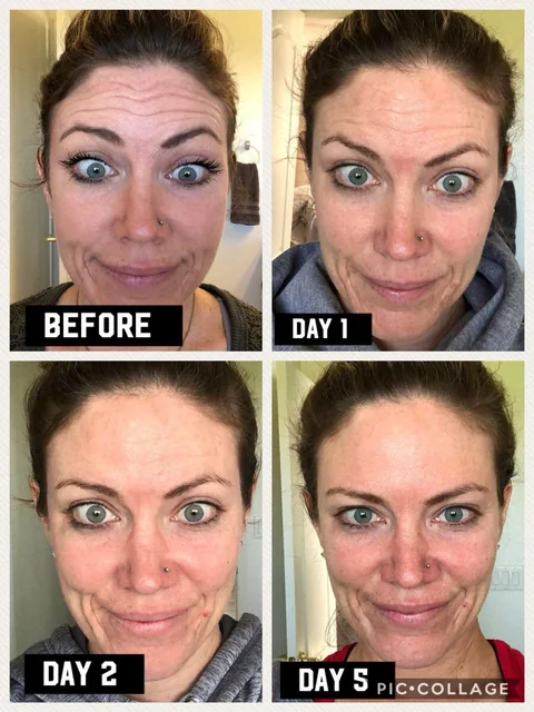 Before and after photos of forehead and frown lines treated with BOTOX, at day 1, 2 and 5