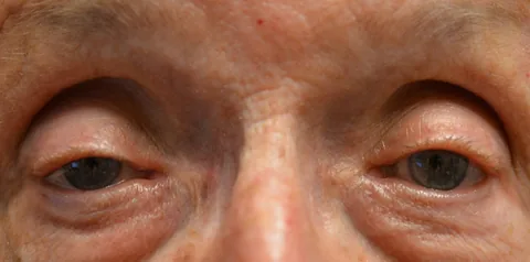 Before ptosis surgery