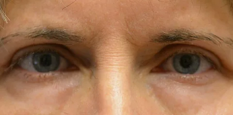 After upper eyelid surgery