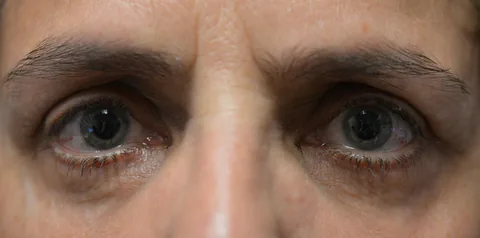 After upper eyelid surgery