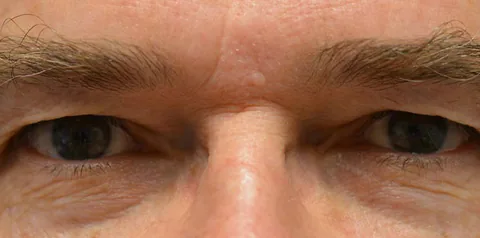 Before upper eyelid surgery