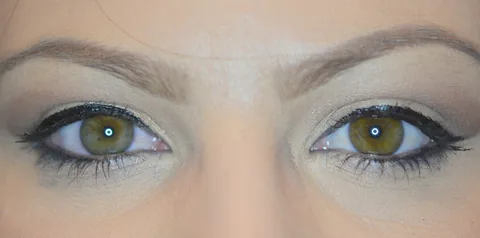 After ptosis surgery