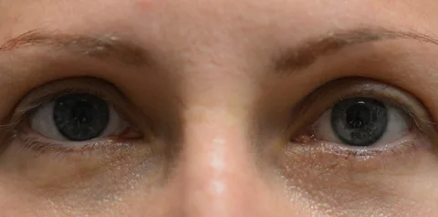 After upper eyelid surgery
