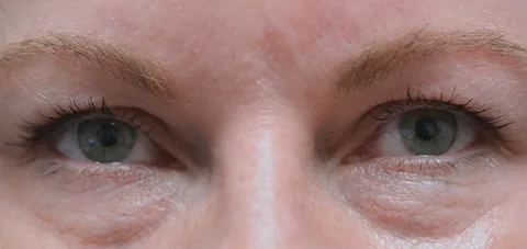Before lower eyelid surgery