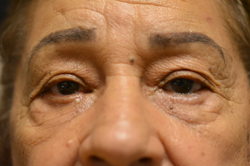 Before eyelid repair