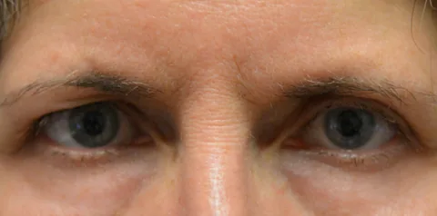 Before upper eyelid surgery