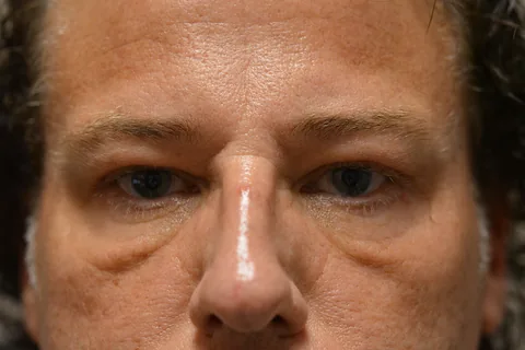 Before eyelid surgery