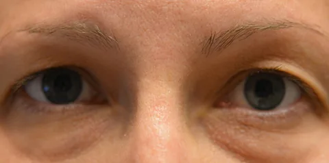 Before upper eyelid surgery