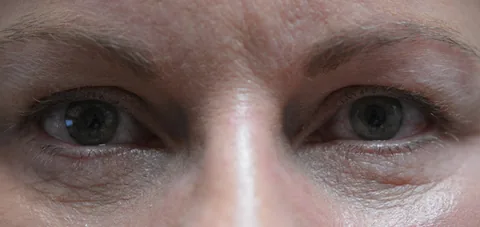 After lower eyelid surgery