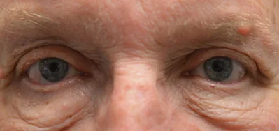 After ptosis surgery