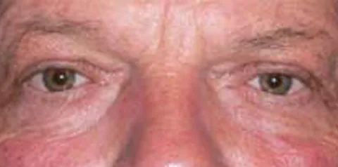 After upper eyelid surgery