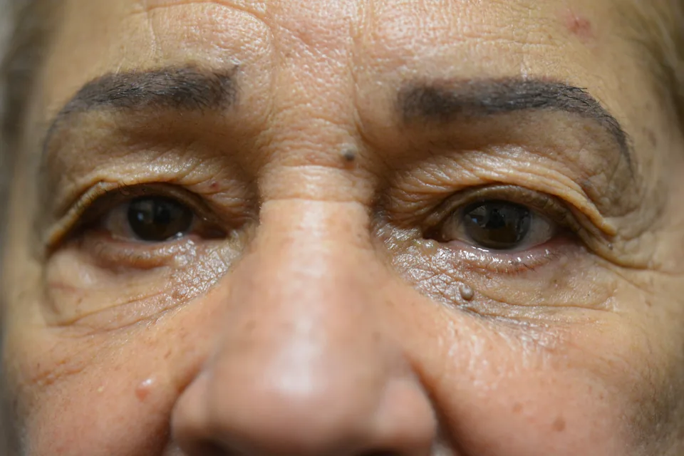 After eyelid repair