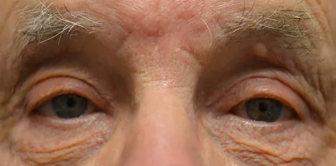 After ptosis surgery