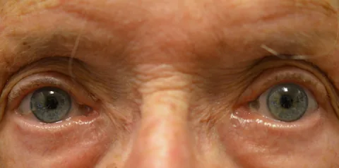 After ptosis surgery