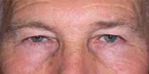 Before upper eyelid surgery