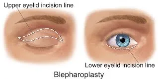 Diagram of the most common incision sites for upper and lower eyelid blepharoplasty