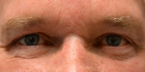 After upper eyelid surgery