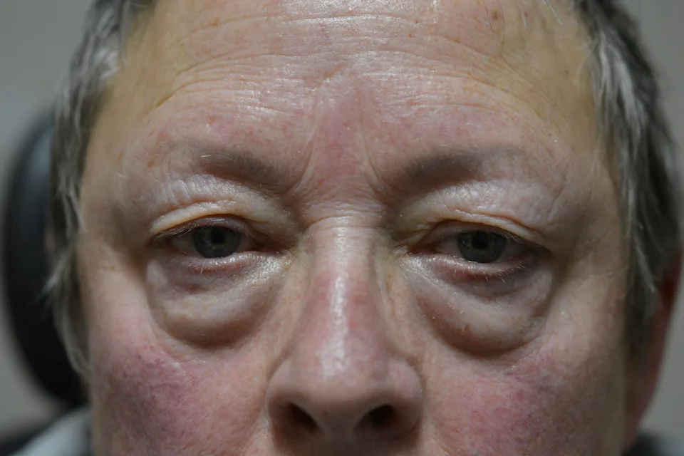 Before lower eyelid surgery