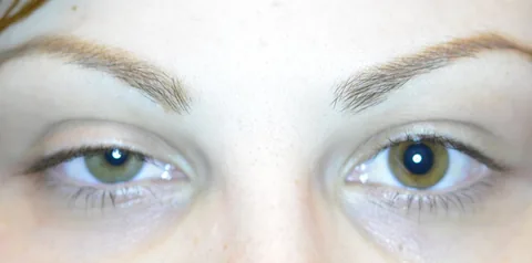 Before ptosis surgery