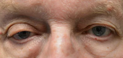 Before ptosis surgery