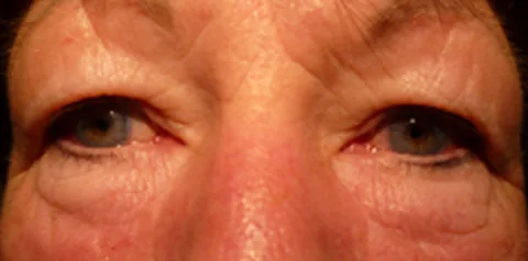Before upper eyelid surgery