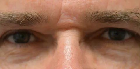 After upper eyelid surgery