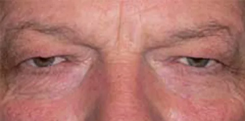 Before upper eyelid surgery
